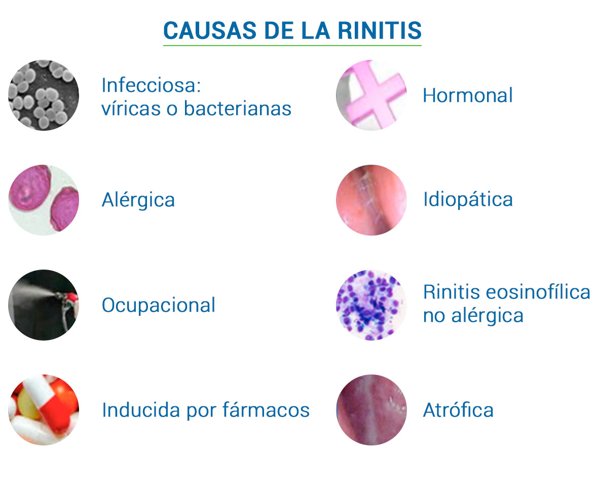 Causas-de-la-rinitis